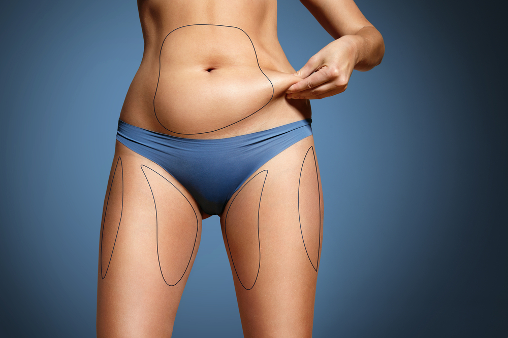 Best Natural Looking Liposuction Results