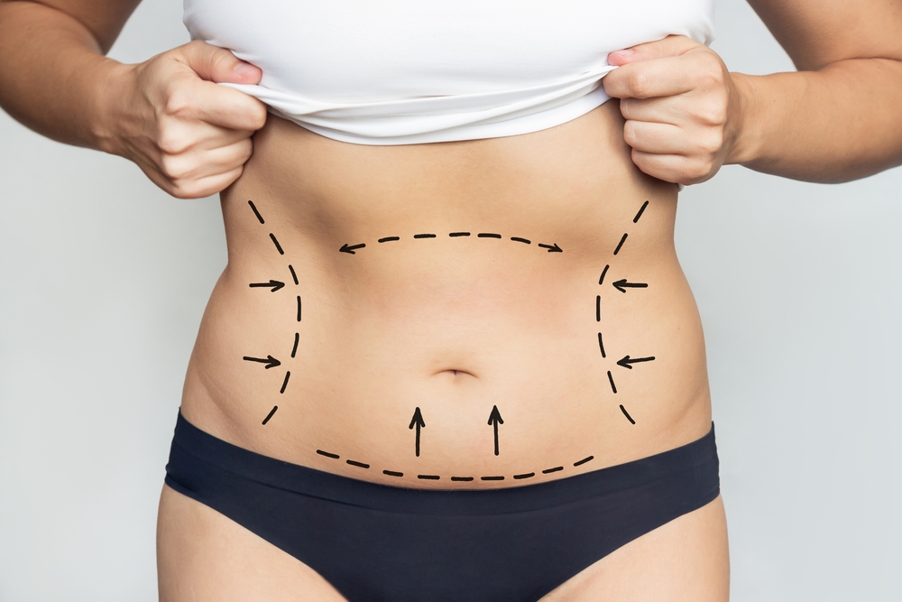 The Best Liposuction Doctor in DC Spills the Secret to Getting the Best Lipo Results