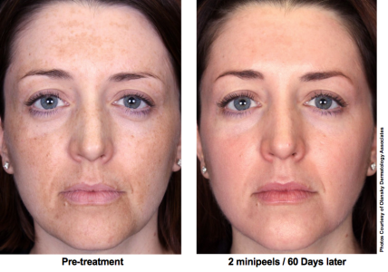 10 Things to Expect After Your First Chemical Peel - U.S. Dermatology  Partners