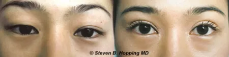 Asian eyelid shop surgery northern virginia