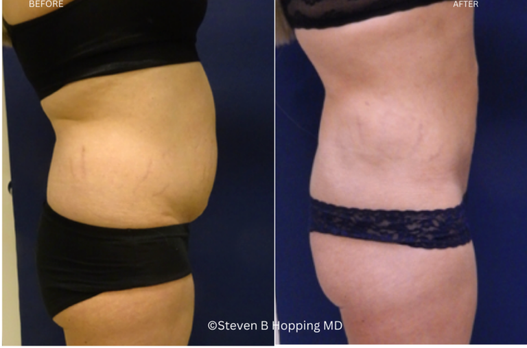liposuction before and after photo
