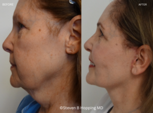 face and necklift before/after photo