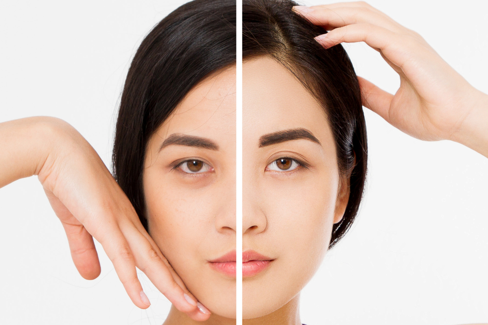 How Long Does a Brow Lift Really Last?