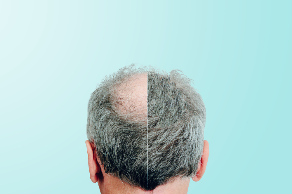 How Much Does Hair Loss Surgery Cost in DC?