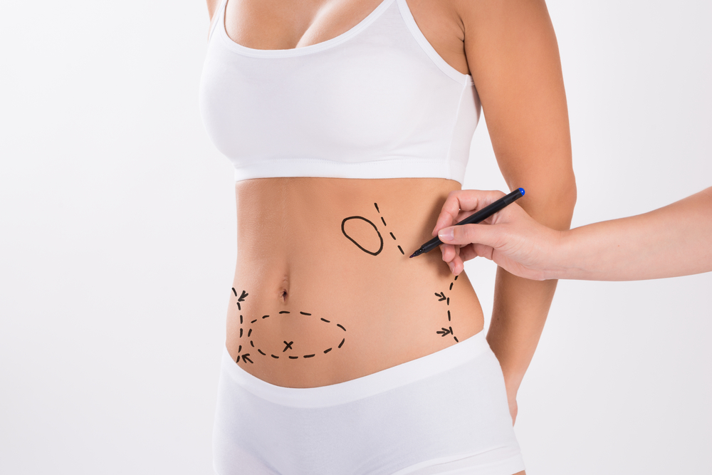 FAQs About Liposuction Cost in DC