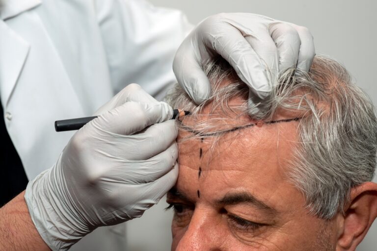 How Much Is the Best Follicular Unit Extraction Cost in DC?