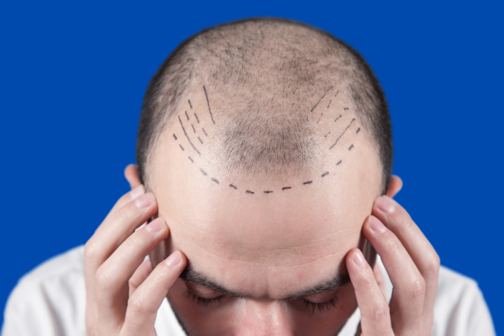 Best FUE Transplant Cost in DC