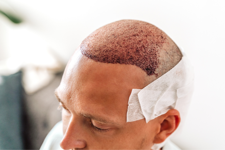 Get FUE Hair Loss Transplants in D.C.