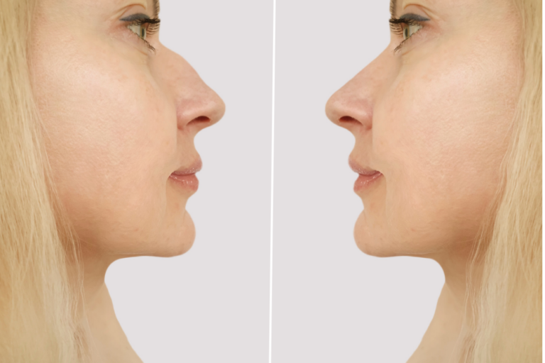 Rhinoplasty Before and Afters in DC