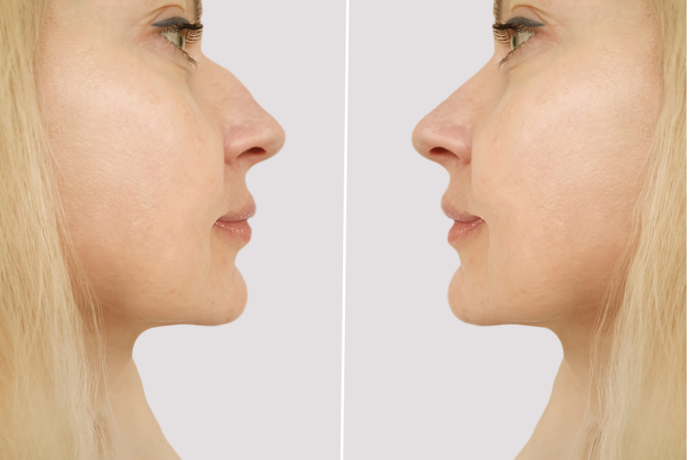 Rhinoplasty Before and Afters in DC