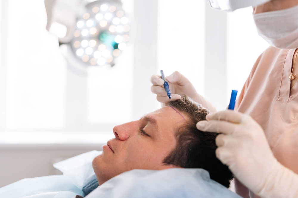 Top Hair Transplant Doctor in DC