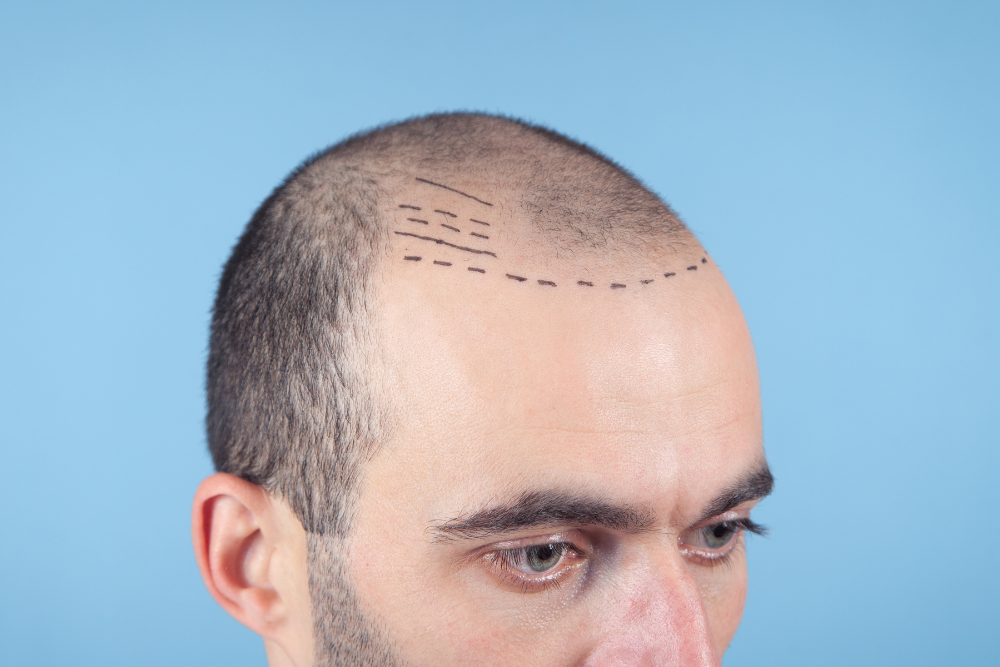 How FUE and FUT Hair Grafts Compare in Cost, Recovery, and Results