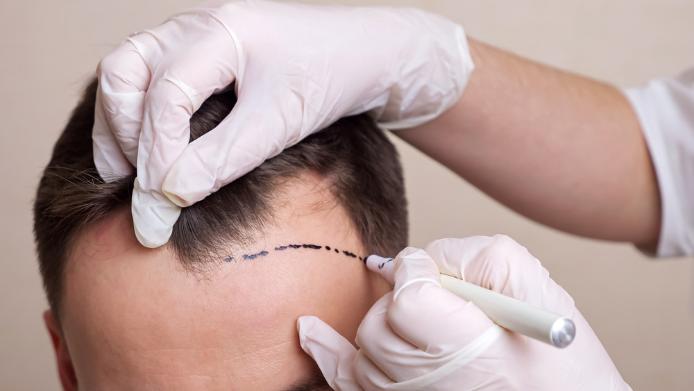 Real Results from DC’s Most Trusted Hair Transplant Surgeons