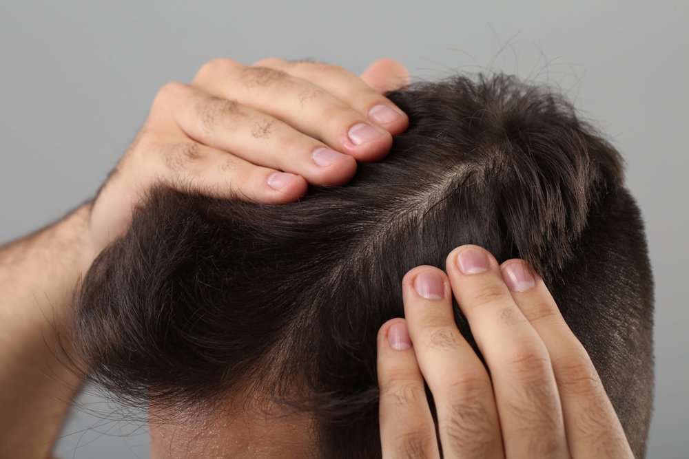 Finding the Best Hair Implant Surgeon in DC: Board-Certified Options