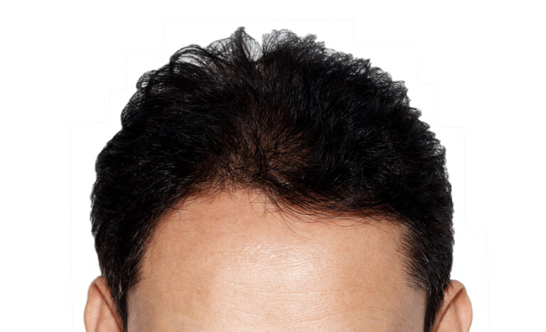 Transparent Hair Graft Pricing with Expert Surgeons in DC