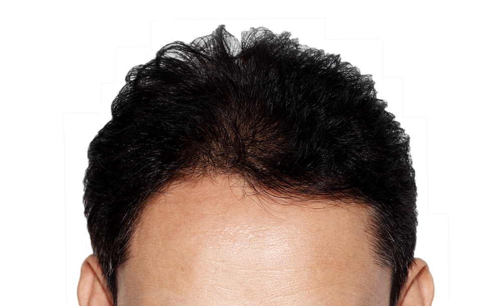 Transparent Hair Graft Pricing with Expert Surgeons in DC