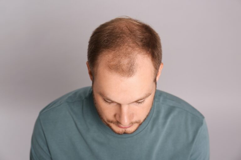 Finding the Right Trichologist or Hair Loss Expert in Washington, D.C. for Early Intervention