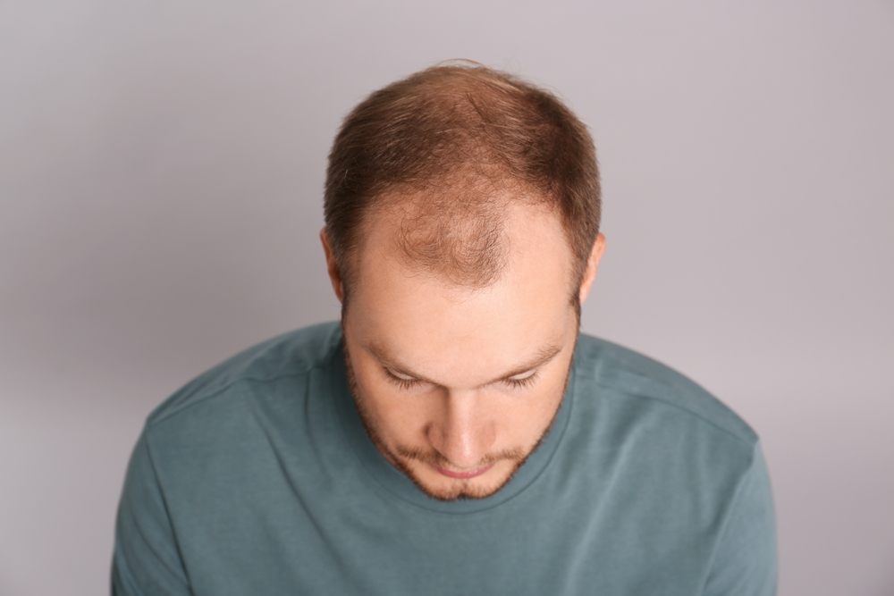Finding the Right Trichologist or Hair Loss Expert in Washington, D.C. for Early Intervention
