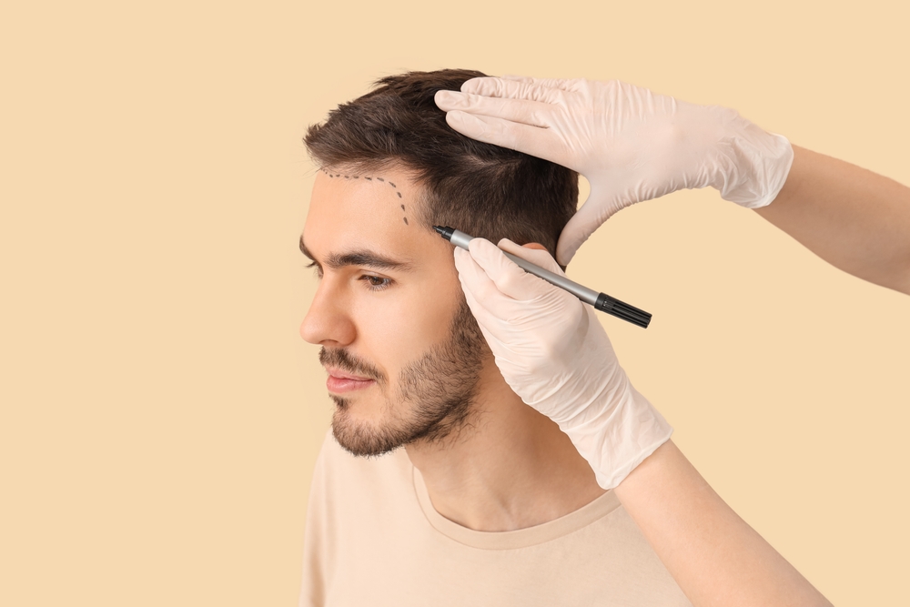 Best Hair Transplant Consultations