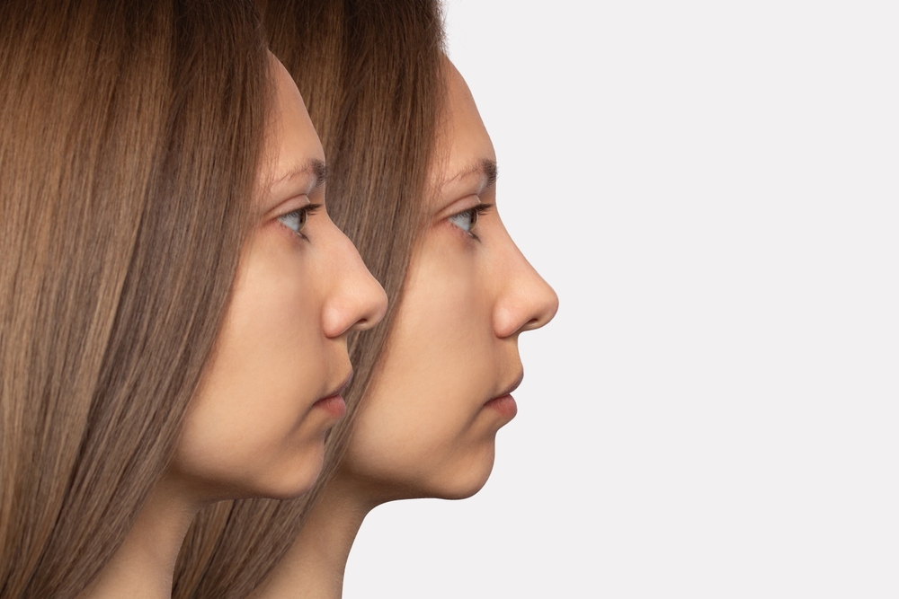 Guide to Natural Looking Rhinoplasty Surgery in Washington, DC