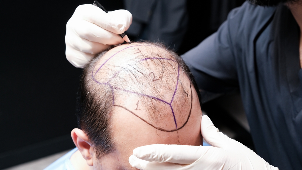 Best Hair Transplant Results Near Georgetown