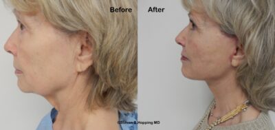 Deepplaneneckfacelift 1 2026