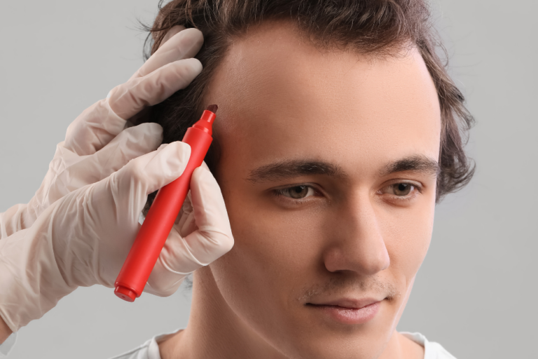 Best Hair Restoration Transplant Options in Washington, DC