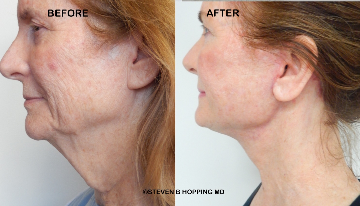 deepplaneface-necklift 2026jpeg