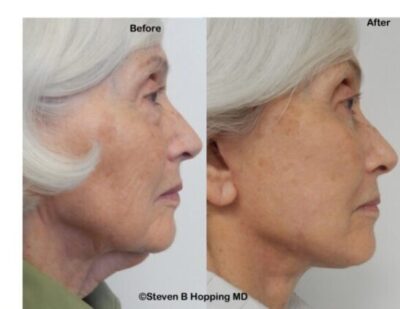 faceliftnecklift 2026 copy