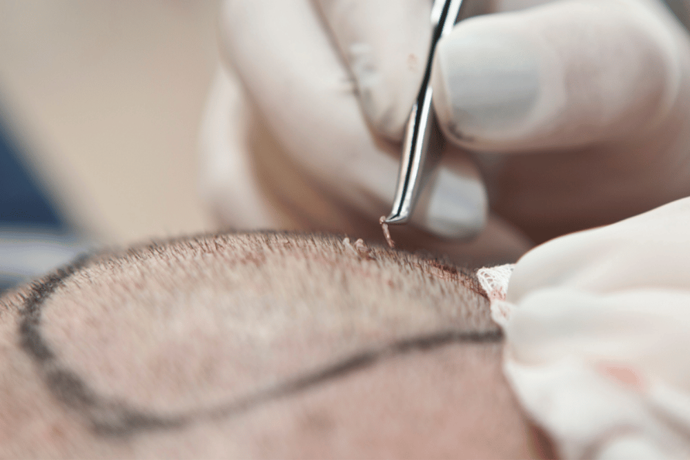 Best Hair Transplant Results in Washington DC
