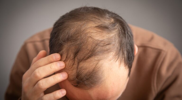 Best Hair Loss Doctor in Washington, DC for Hair Restoration