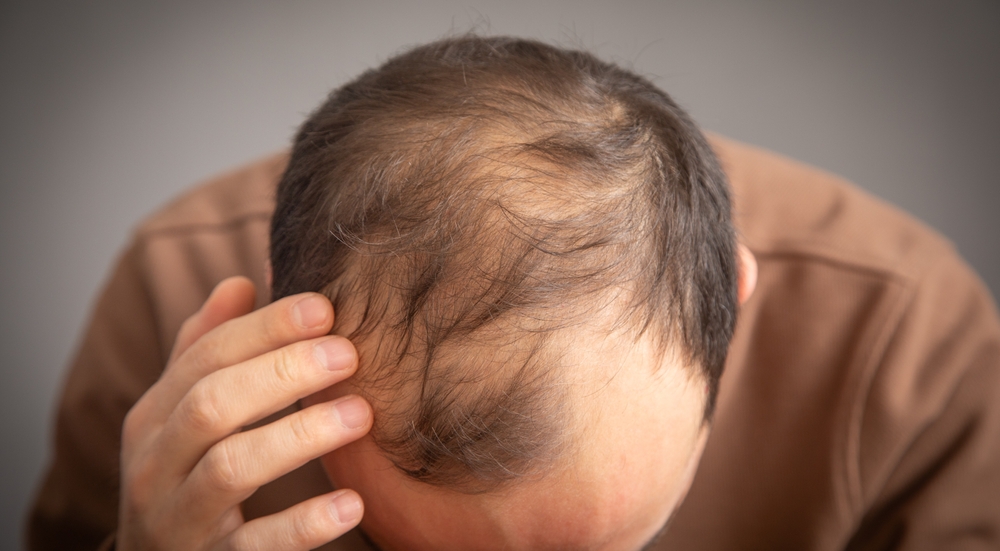 Best Hair Loss Doctor in Washington, DC for Hair Restoration