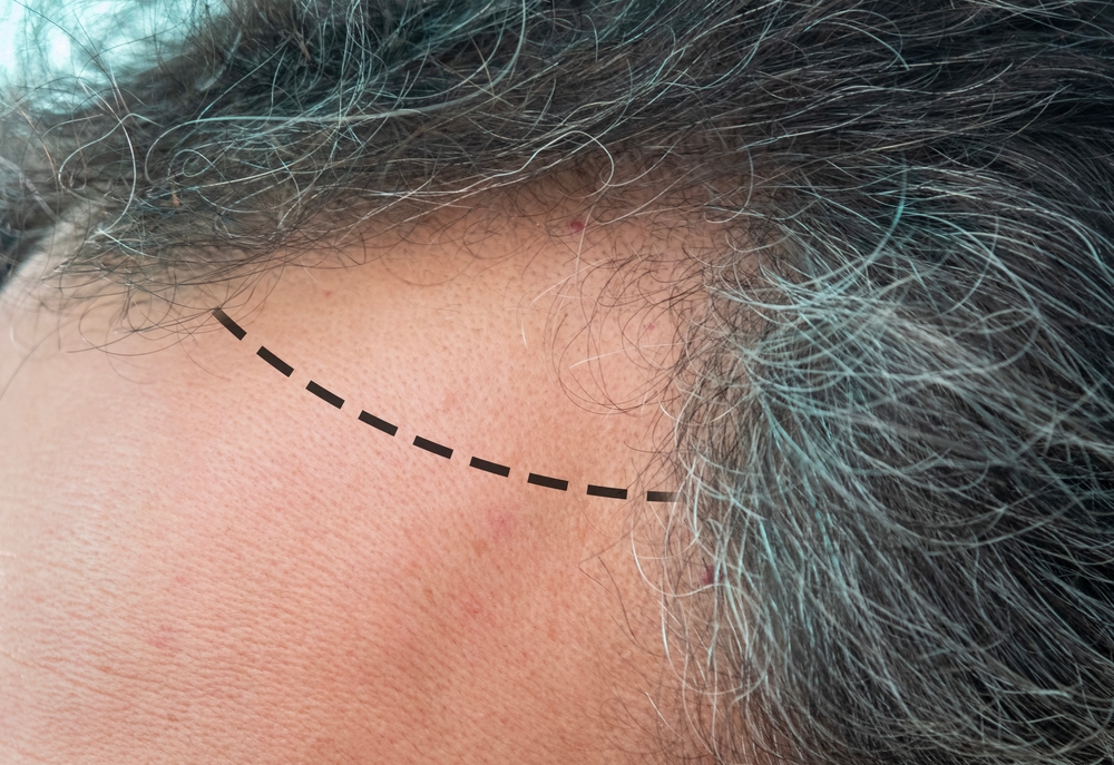 Best Hair Transplant Surgeon in Washington, DC