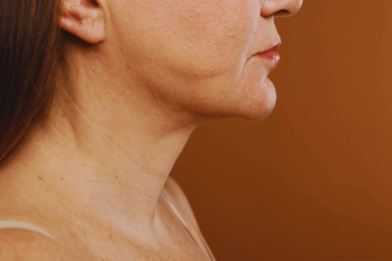 Best Neck Lift Results Washington DC