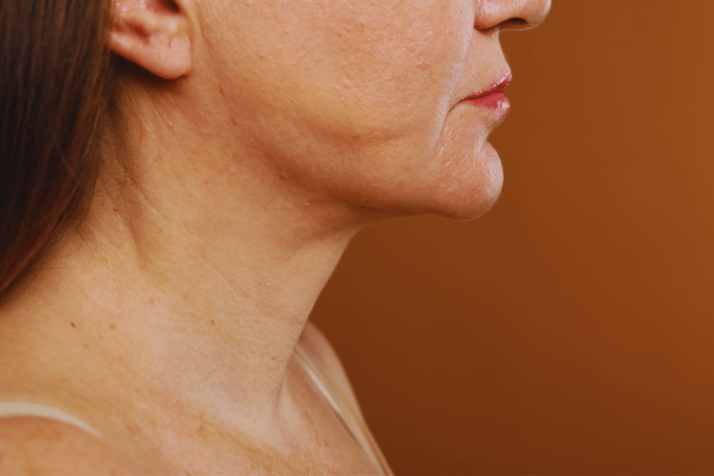 Best Neck Lift Results Washington DC