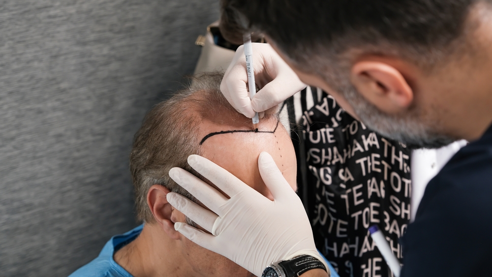 Dr. Hopping is one of the best hair transplant surgeons in DC