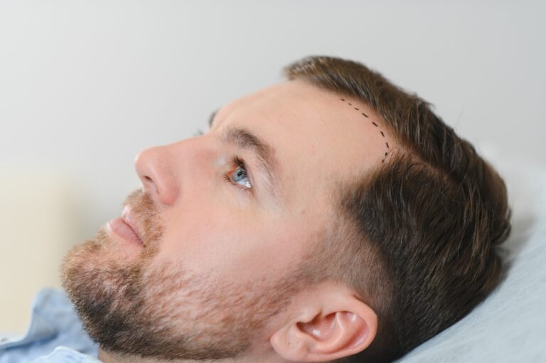 young man looking to fix a receding hairline in DC