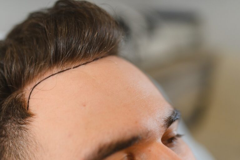 man with a mature hair line waiting for transplant doctor