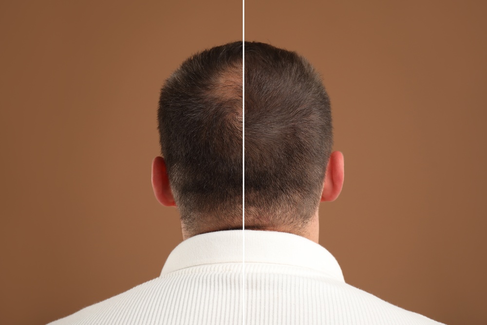 some hair transplants look amazing like this one