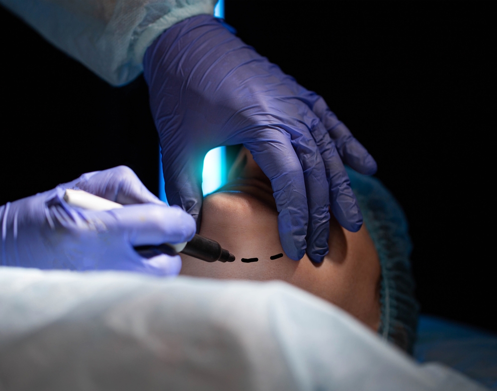 patient getting ready for chin liposuction in DC