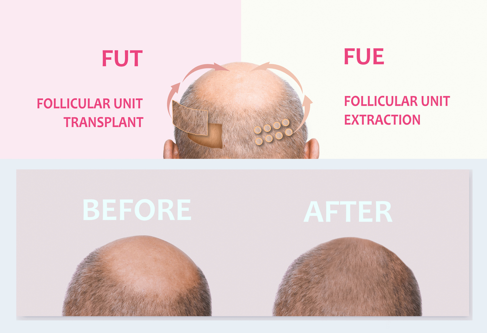FUE or FUT hair transplant in DC
