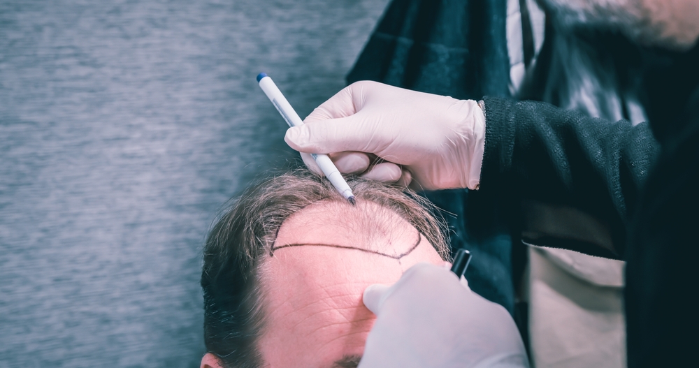 leading hair transplant surgeon in DC mapping hairline