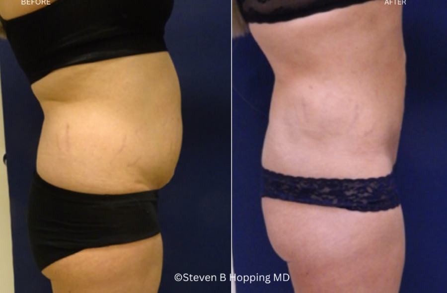Before and after body contouring
