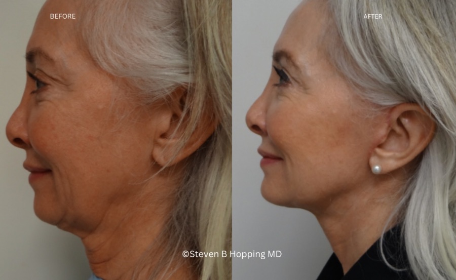 Before and after facelift and neck lift