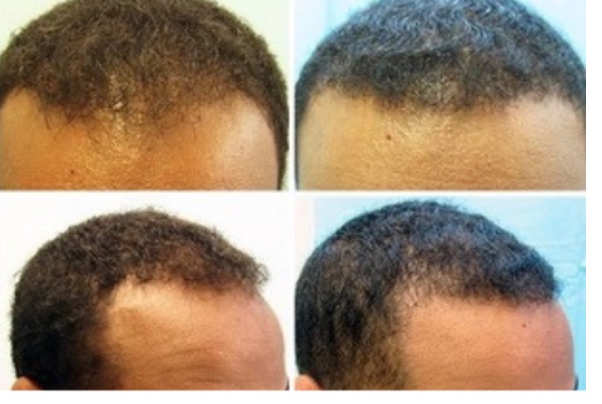 Before and after hair restoration