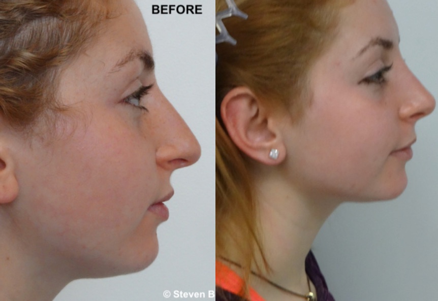 Before and after rhinoplasty