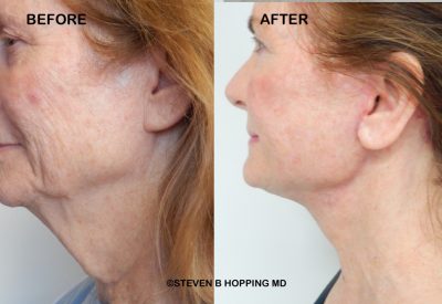 deepplaneface-necklift 2026jpeg